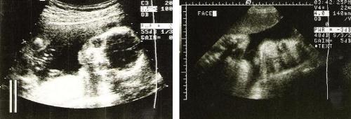Ultrasound pictures - Ultrasound pictures of my kids.