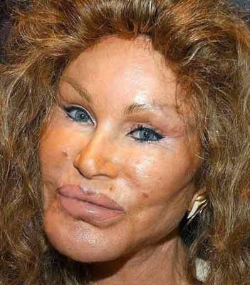 Plastic surgery victim - This woman went to far.She wanted to look better.