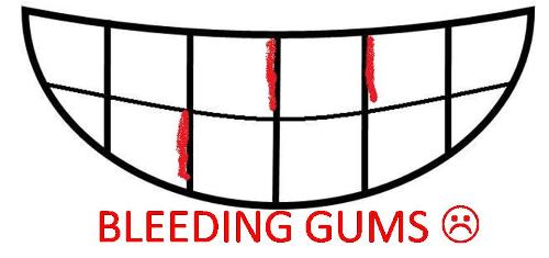 bleeding gums caricature - a caricature photo of teeth with bleeding gums