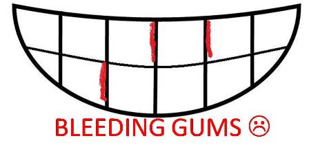 bleeding gums caricature - a simple caricature of teeth with bleeding gums.