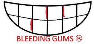 bleeding gums caricature - a simple caricature of teeth with bleeding gums.
