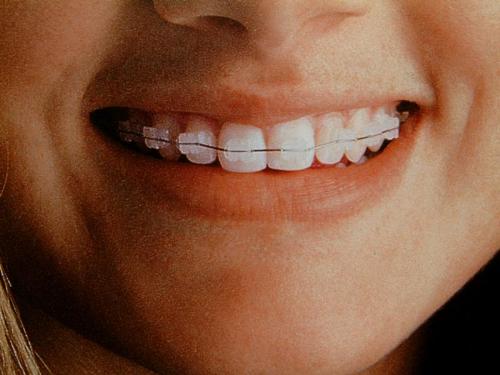 Braces - Clear Braces