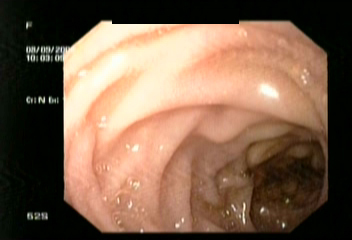 endoscope (D1) - D1 Junction