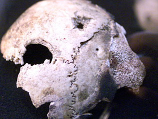 Hitler_skull - DNA test shows Hitler skull is that of a woman