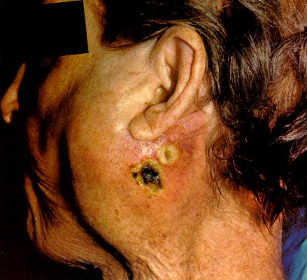 parotitis - how do we get this kind of disease?