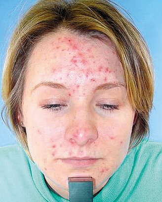 Acne - It's very annoying..
