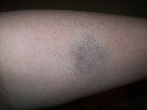My Bruise - Bruise on my arm.