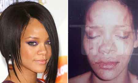 Rihanna before and after being beaten by her ex - Rihanna before and after being beaten by her ex boyfriend