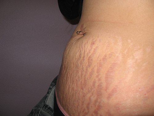 stretch marks - awful stretch marks