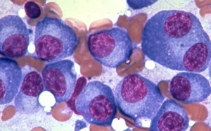 Leukemia - Cells - Leukemia is the abnormal growth of white blood cells known as leukemia cells in the bone marrow that over time can swarm out the normal blood cells leading to major complications like anaemia, bleeding and infections.
