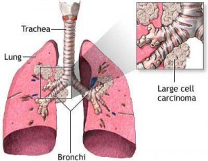 Lung cancer - Lung Cancer- Causes Symptoms and treatment !!