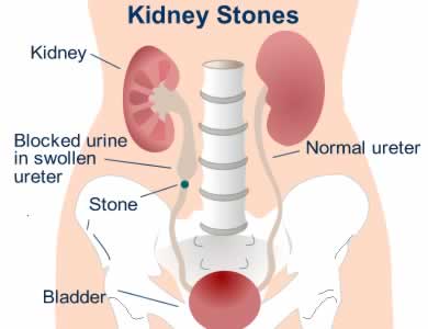 kidney stones - best home remedies