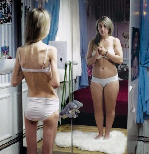 an image of an anorexic - anorexia nervosa  http://images.search.yahoo.com/images/view?back=http%3A%2F%2Fsearch.yahoo.com%2Fsearch%3Fei%3DUTF-8%26p%3Danorexic%2Bimage&w=720&h=742&imgurl=loscuatroojos.com%2Fwp-content%2Fuploads%2F2008%2F05%2Fanorexic-view.jpg&size=64.5kB&name=anorexic+view+jpg&rcurl=http%3A%2F%2Fwww.zappafly.com%2Fanorexic.html&rurl=http%3A%2F%2Fwww.zappafly.com%2Fanorexic.html&p=anorexic&type=jpeg&no=1&tt=29%2C554&oid=a4df8e9e7113d1d6&tit=anorexic+view+jpg&sigr=115u53itl&sigi=11unvhps2&sigb=11o4lamtd#FCar=a4df8e9e7113d1d6