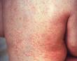 Measles - Rushes, measles, rubella, german measles Measles - Rushes, measles, rubella, german measles