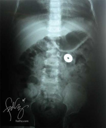 button,swallowed,accident - my niece accidentally swallowed a button
