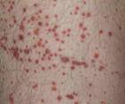 Purpura - Purpura - skin disease