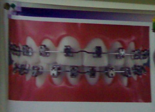 braces - photo of teeth with braces