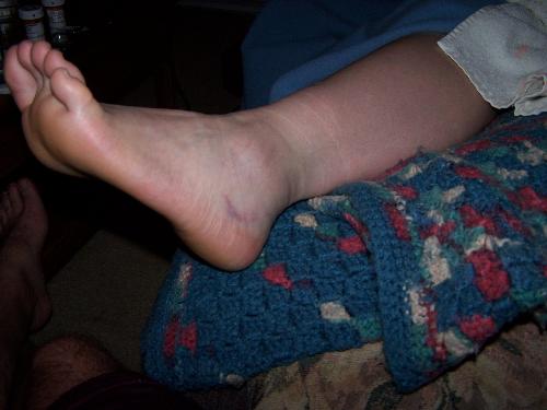 My Ankle - Day 2 of the sprain