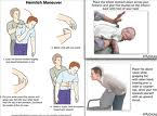 Heimlich maneuver - Performing heimlich maneuver to save life.