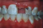 Badteeth, toothache - Bad teeth leads to toothache and pain. Look after your teeth and visit the dentist regular. Brush your teeth with toothpaste at least twice a day, especially before retiring to bed. Use a mouth wash during the day.