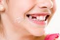 Toothless smile - Now there are new composite resins available. They are long lasting and strong.