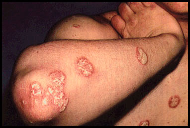 psoriasis - just a photo of a skin disorder called posriasis psoriasis - just a photo of a skin disorder called posriasis