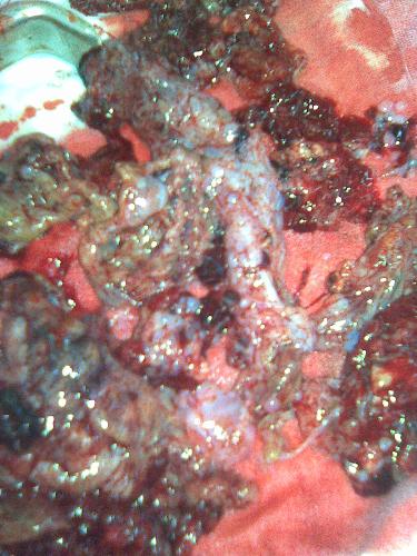 The vesicular tissues we got. - Hydatidiform mole is an abnormal kind of pregnancy.