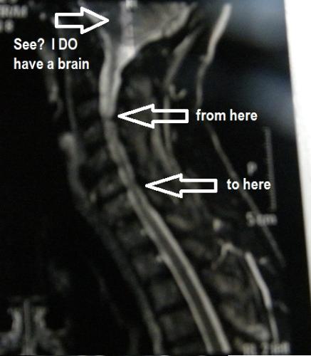 My poor neck - This view shows a lot of impingement but the only really serious problem is one herniated disc, which the surgeon is going to remove, then put in a stabilizer plate to hold the two discs apart. Ain't life grand?