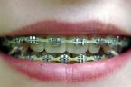 these are metal ones - braces