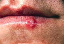 Cold Sore - This is just a little Cold Sore its nothing to the cold sores that youll see on Google images. This Cold sore is nothing but a baby hahaa... If you want to leave a comment of this picture be my guess lol Cold Sore - This is just a little Cold Sore its nothing to the cold sores that youll see on Google images. This Cold sore is nothing but a baby hahaa... If you want to leave a comment of this picture be my guess lol
