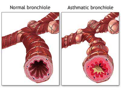 How Asthma Occurs. - This is the cause.The bronchiole on the right is an Asthmatic Bronchiole.Compared to the left the asthmatic bronchiole as you can see is inflated/irritated and 50% covered in mucus.That causes us asthmatics to wheeze,cough and have short breath. 