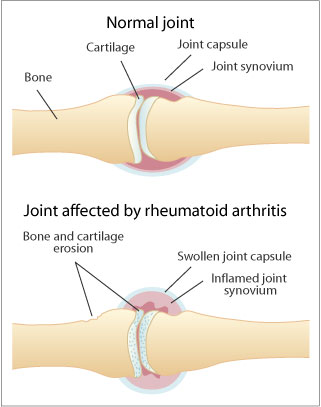 Rheumatoid Arthritis - Joint showing a normal joint and one affected bt Rheumatoid arthritis