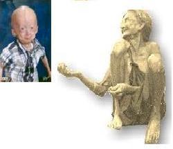 progeria patient and a degenerate - The photo shows two characters. The child on the left is suffering from a rare disease called &#039;Progeria&#039; in which a child of 7 looks to be 70 !
The person on the left is a degenerate.

