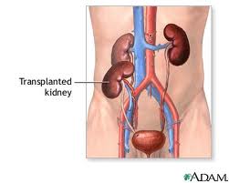 kidney transplant - downloaded from internet