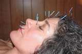 acupuncture - does it work?
