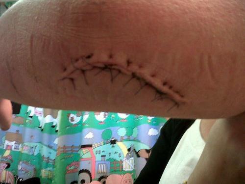 The scar - Helen's scar just before stitches were removed! The scar - Helen's scar just before stitches were removed!