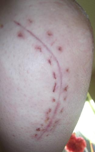 4 days on - Looking so much better after only 4 days!!