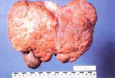 Liver - Liver cirrhosis a serious illness.