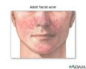 Acne - Acne can be caused by dirt and oil on the skin or can be triggered by stress or pollution. Acne - Acne can be caused by dirt and oil on the skin or can be triggered by stress or pollution.