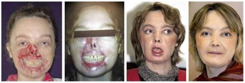 Isabelle Dinoire, transplant - Success stories of transplant patient a French citizen face, Isabelle Dinoire. The woman is the first patient who underwnt successful partial face transplant in 2005 at the Vall d&#039;Hebron in Barcelona University Hospital.