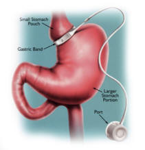 Lap Band Surgery - Involves placing an inflatable silicone band around the upper portion of the stomach. It reduces the size of the stomach limiting the amount a patient can eat. This procedure is a better alternative to gastric bypass surgery because its reversible.