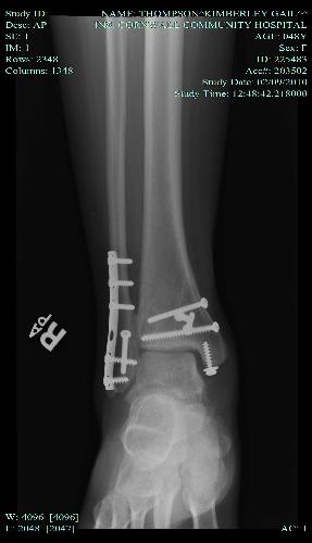 Broken Ankle - This is the xray taken after surgery on my broken ankle