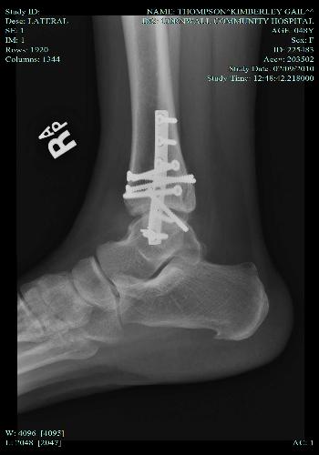 Broken Ankle 2 - broken ankle after surgery