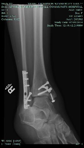Broken Ankle 3 - Broken ankle after surgery