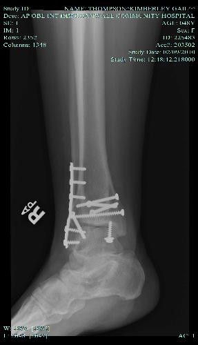 Broken Ankle - Broken ankle after surgery
