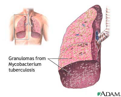 Tuberculosis - Tuberculosis usually attacks the lungs but can also affect other parts of the body. It's transferred through inhalation of the virus from a person affected who sneezes or coughed. It can cause death but is already treatable in this time.