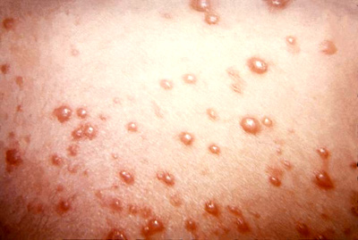 chicken pox - chicken pox is a contagious disease caused by varicella zoster virus. A person can only have this at once and he/she will be immune to it