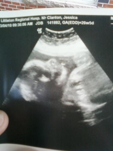 my ultrasound - my ultrasound of my daughter