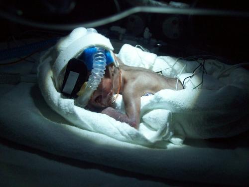 My preemie - This is my daughter 2 days after she was born.