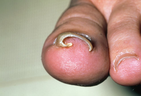 Ingrown Toenail - Ingrown toenail before it gets infected.
